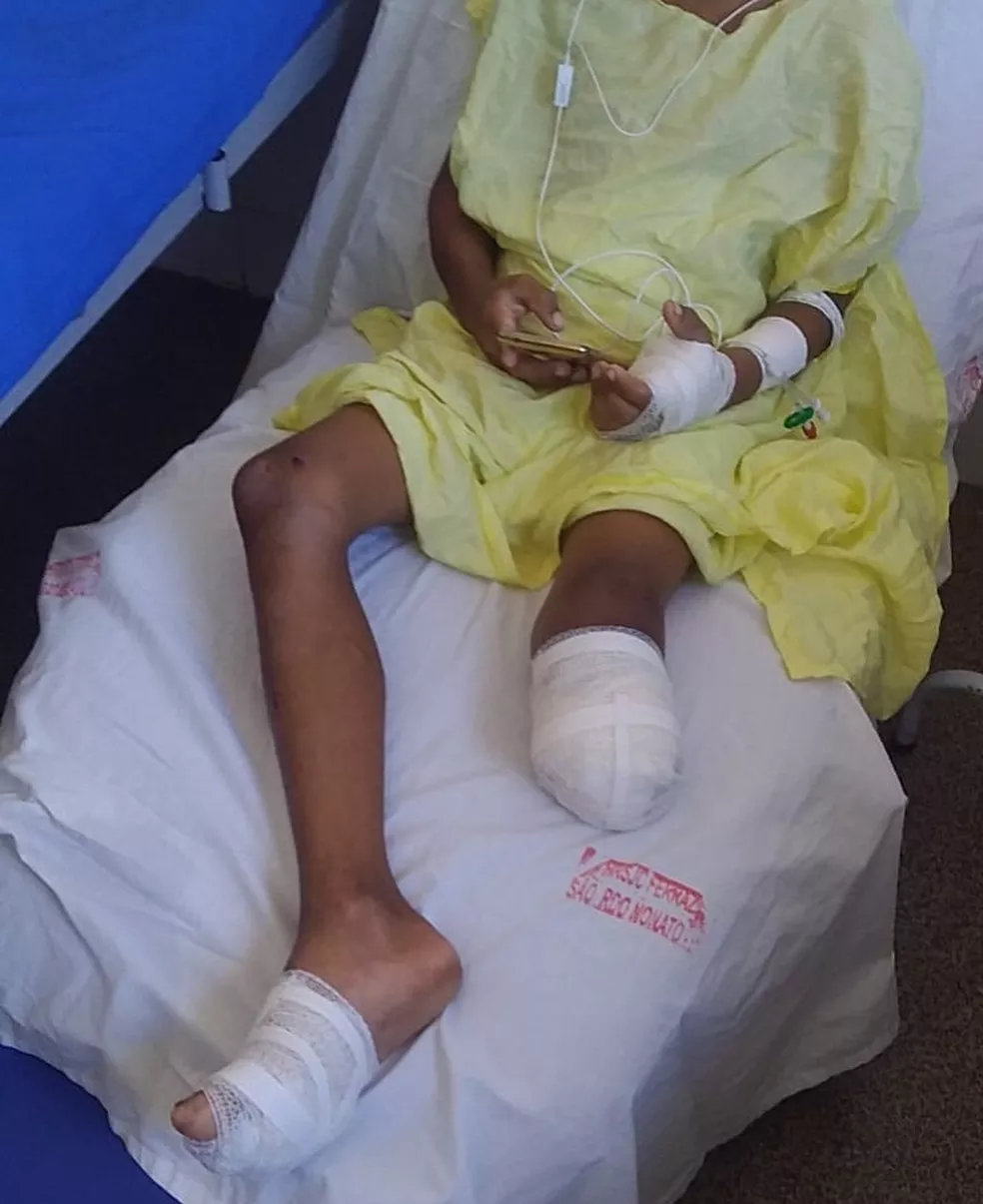 _Criança com perna amputada após acidente com ônibus escolar