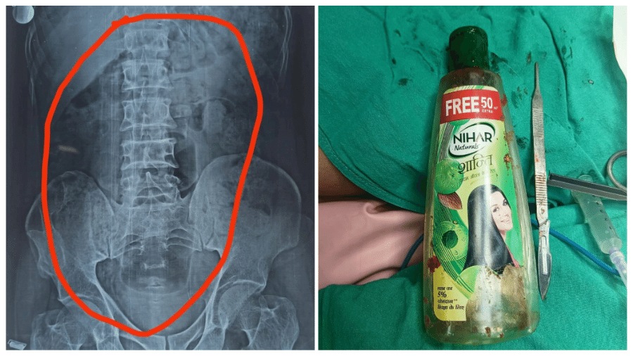 Homem engole garrafa plástica e passa por cirurgia de emergência na Índia