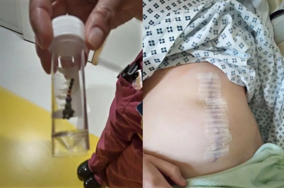 Menina perde parte do intestino após engolir bolas magnéticas na Inglaterra