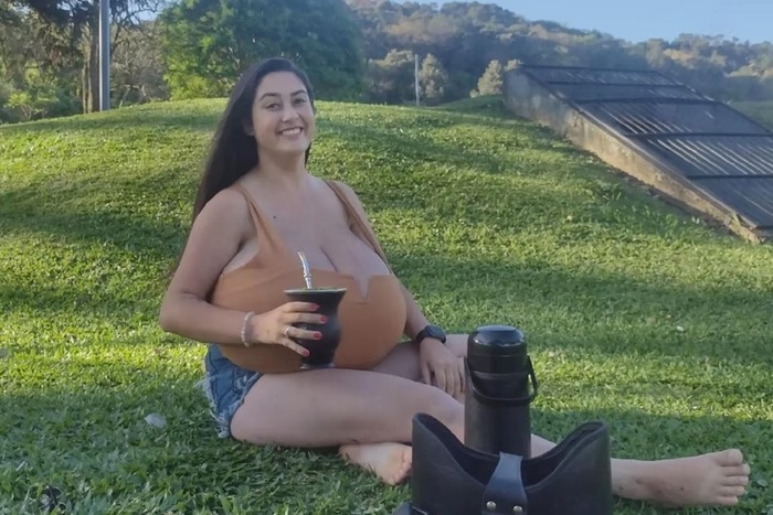 Mulher de 21 anos com gigantomastia retira 10 kg de mama em cirurgia