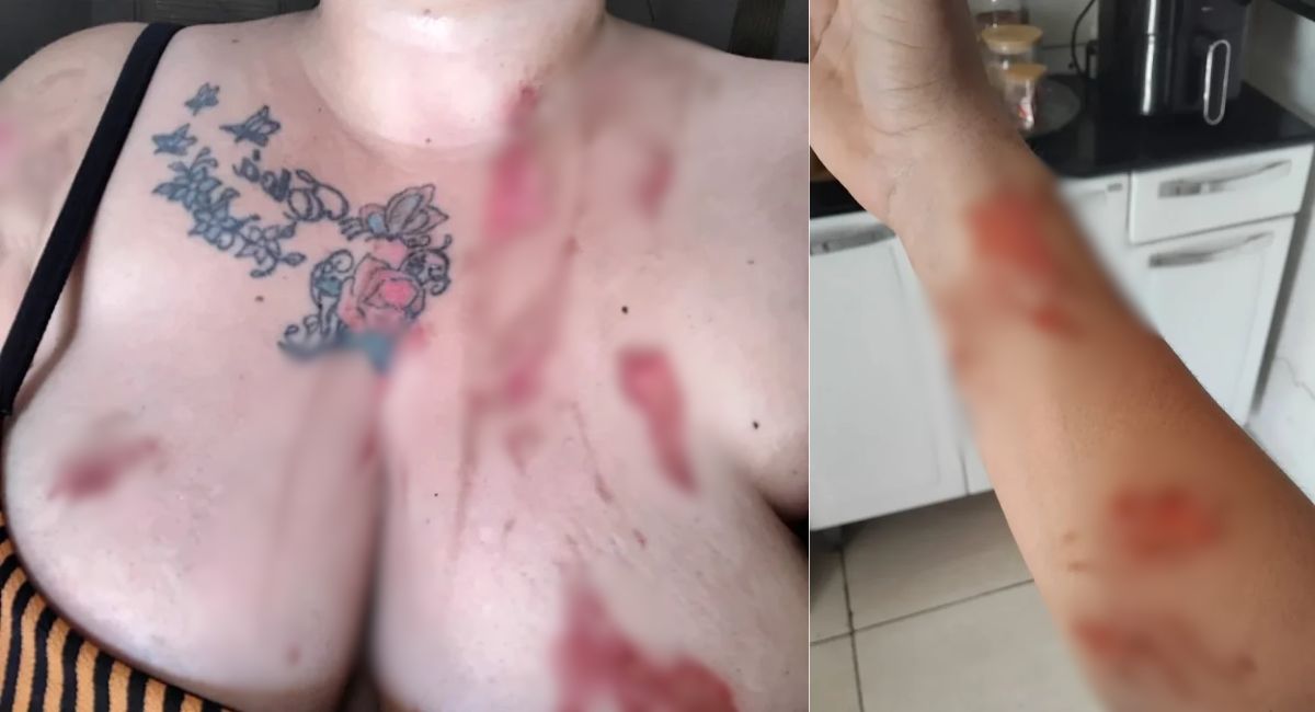 Jovem sofre queimaduras após explosão de panela de pressão colocada na torneira no Piauí