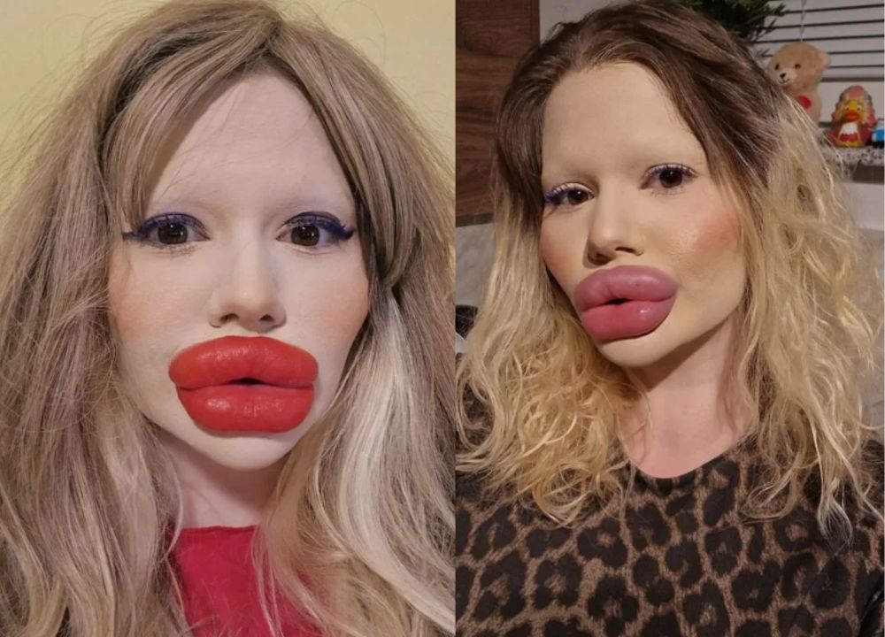 Mulher gasta mais de R$ 140 mil para ter os maiores lábios do mundo