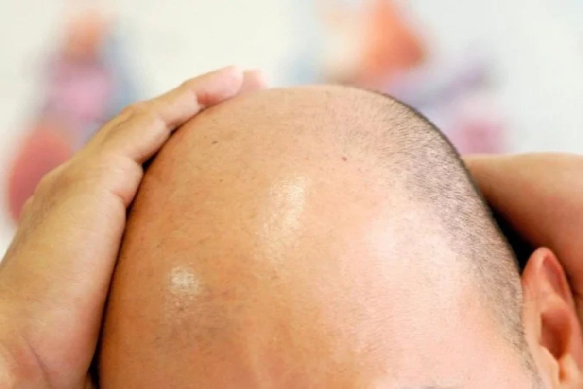 Fim dos carecas? Cientistas criam produto que faz o cabelo voltar a crescer
