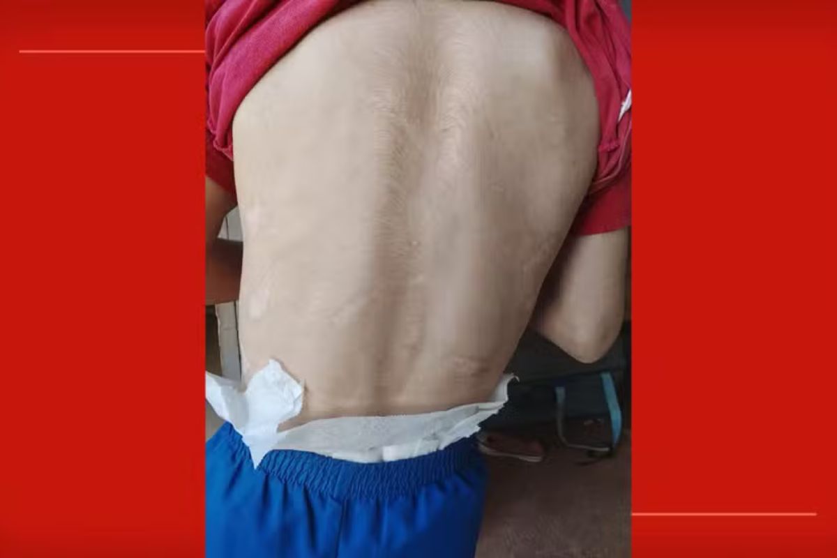 Madrasta é suspeita de queimar menino de 8 anos com garfo quente no DF
