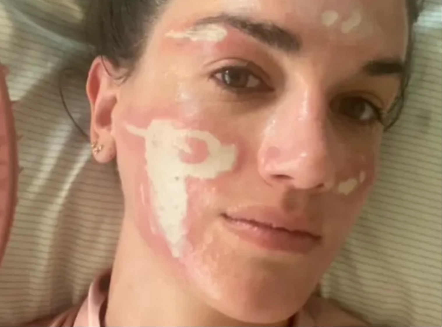 Esteticista de famosas perde licença após causar lesões em cliente