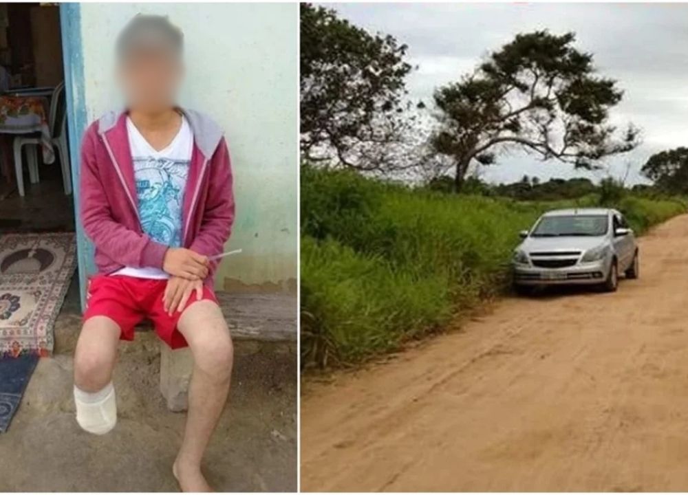 Servidor amputa a propria perna para aplicar golpe de R$ 1,5 milhão no seguro