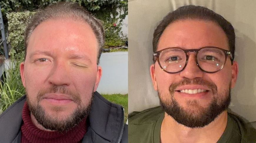 Jornalista Felipe Pereira relata complicação no olho após aplicação de botox