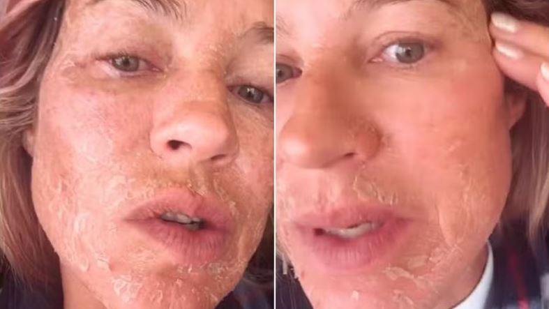 Luana Piovani explica mudança na pele após procedimento estético