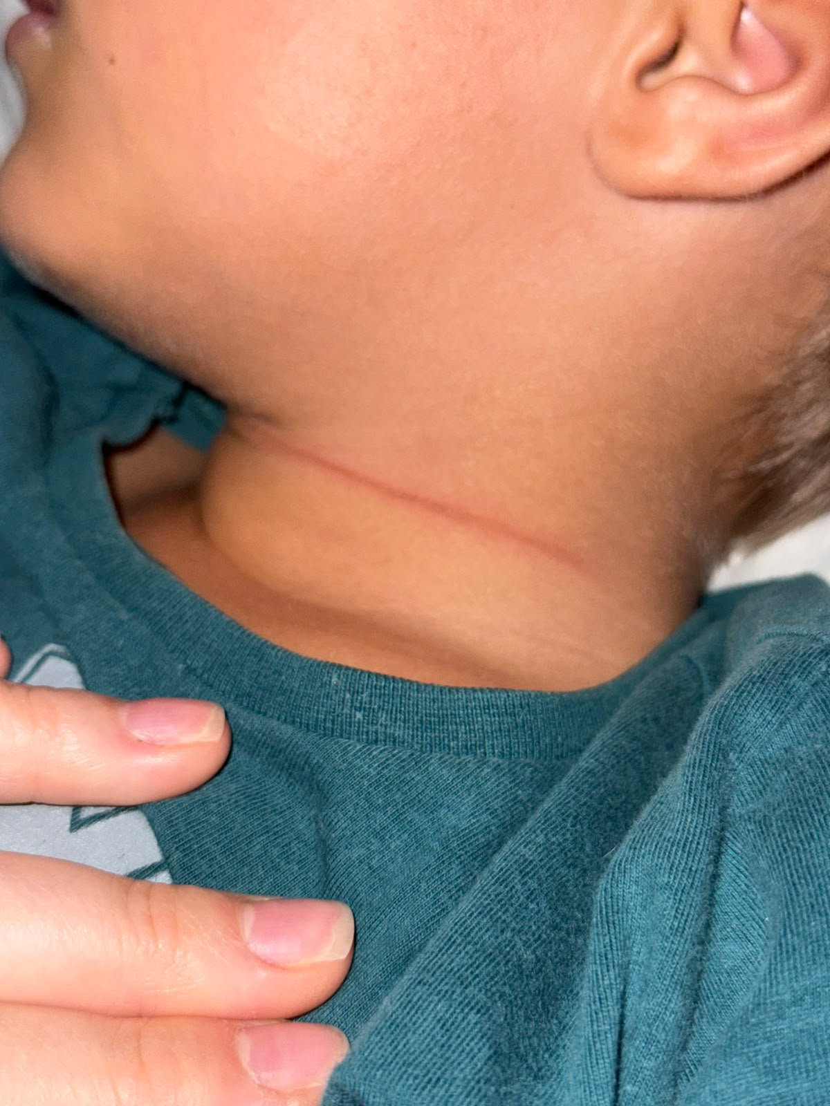 Menino de 4 anos tem pescoço cortado por linha com cerol em Parnaíba; mãe denuncia