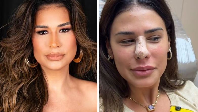 Outra pessoa! Simone Mendes surpreende com resultado de rinoplastia