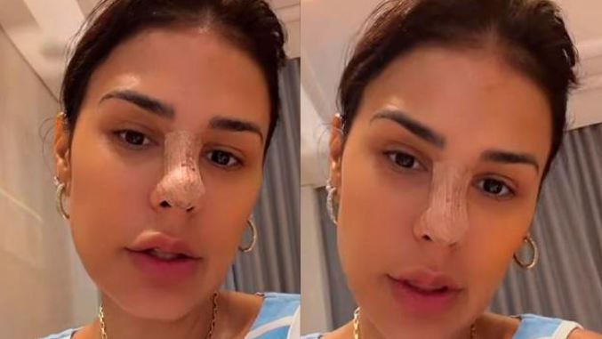 Simone Mendes surge de curativo e revela procedimento no nariz