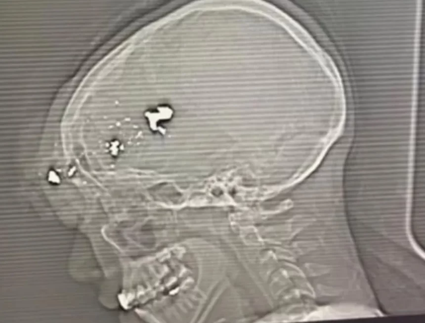 Radiografia mostra bala alojada antes de cirurgia