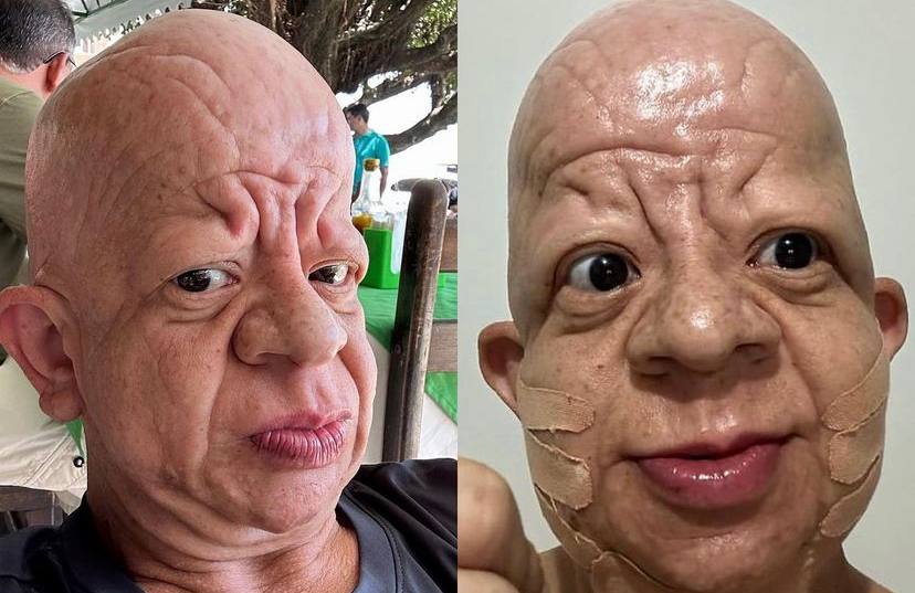 Paraense Bruno Diferente faz harmonização facial e mostra