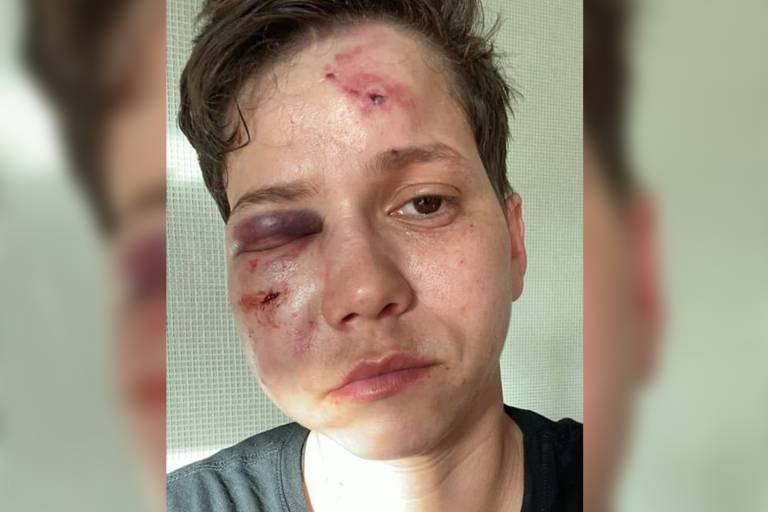 Youtuber apoiadora de Bolsonaro tem rosto desfigurado após 