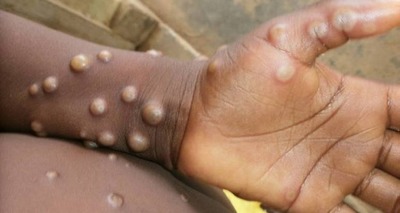 Thumb variola macaco 18052022101415711