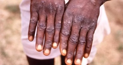 Thumb variola dos macacos