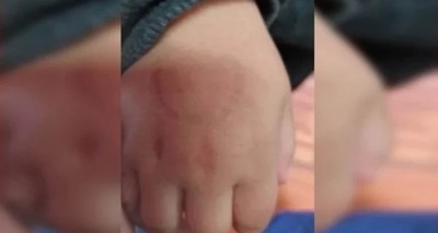 Thumb diretora morde crianca de 4 anos em rs compressed 600x400