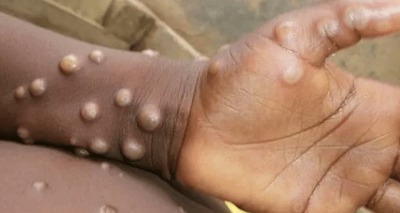 Thumb bahianoar caso suspeito de variola dos macacos na bahia e descartado variola macacos