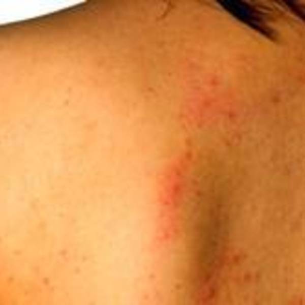 Acne no ombro e no colo: dermatologista lista cuidados para tratar e ...